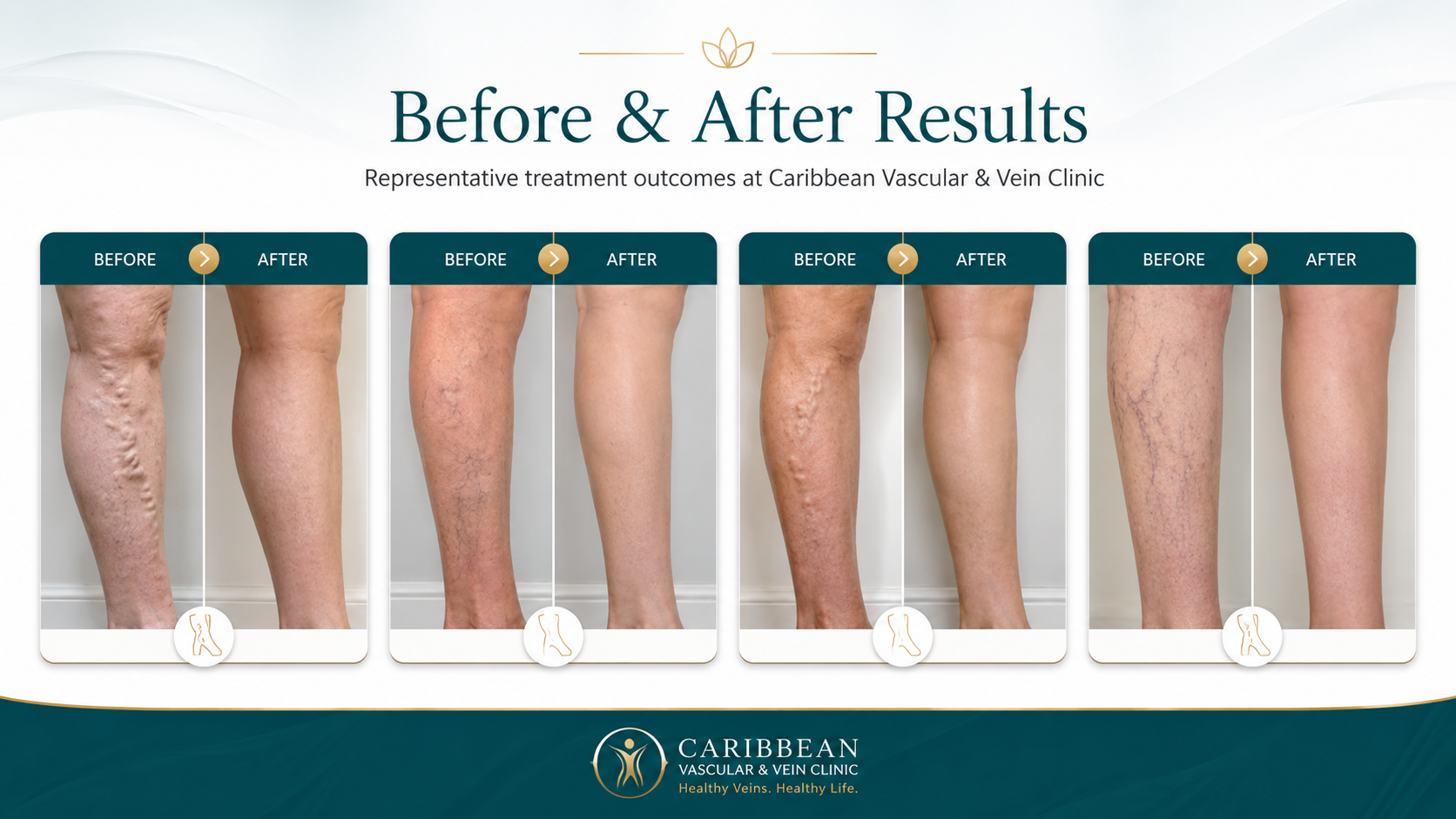 CVVCL Before After veins before and after